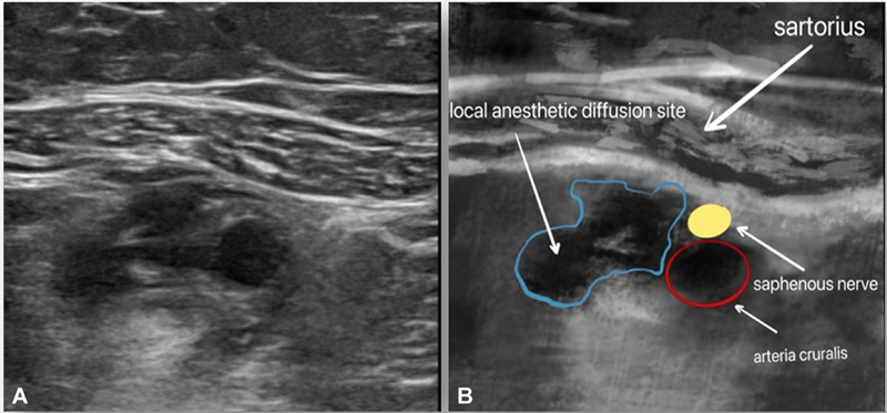 Analgesic Effect of Intermittent Multiple IPACK Block Combined with ACB in Patients with Flexion Contracture Knee Arthritis Undergoing Total Knee Arthroplasty.