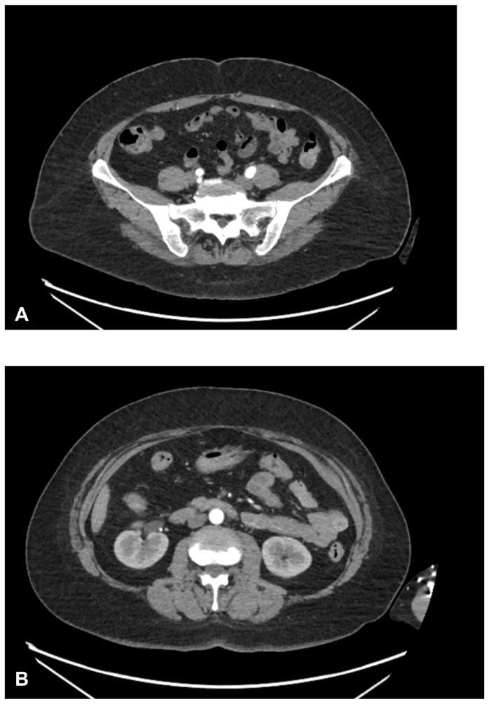 It Runs in the Family: A Rare Case of Familial Idiopathic Colonic Varices.