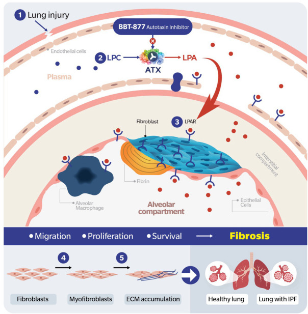 Phase 2 study design and analysis approach for BBT-877: an autotaxin inhibitor targeting idiopathic pulmonary fibrosis.