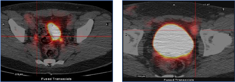 Unusual Long-Term Survival in an Adult Patient With Langerhans Cell Histiocytosis and Central Nervous System Involvement: A Case Report.