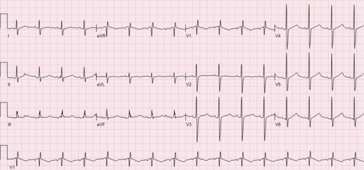 Acquired Genotype-Positive Long QT Syndrome After Pediatric Heart Transplantation.