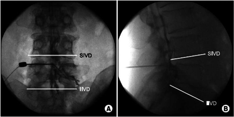 Epidural Contrast Patterns and Clinical Implications: An Educational Review.