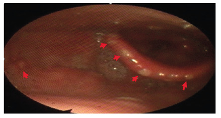 A Case of Doxycycline-Induced Esophagitis Accompanied by Oral Aphthous Ulcers and Laryngitis.