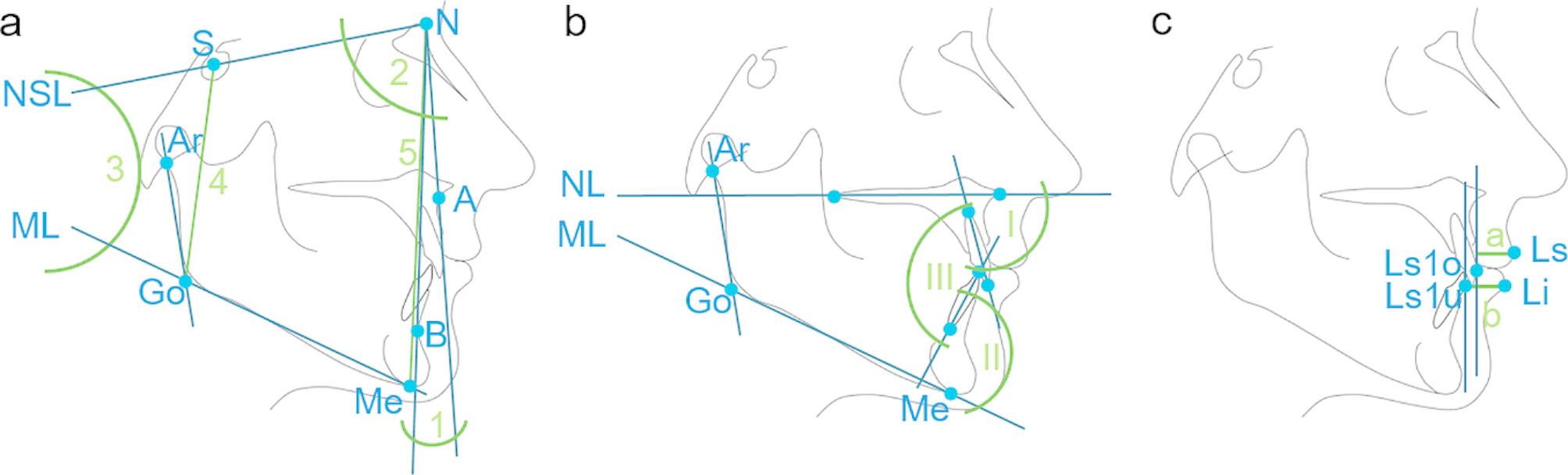 Predictors of changes in incisor inclination during orthodontic levelling and alignment with fixed appliances: a retrospective cross-sectional study.