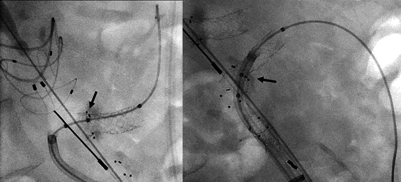 Staged Therapy of Polyaneurysmal Disease Including the World's First BeFlared Use in Anaconda FEVAR.