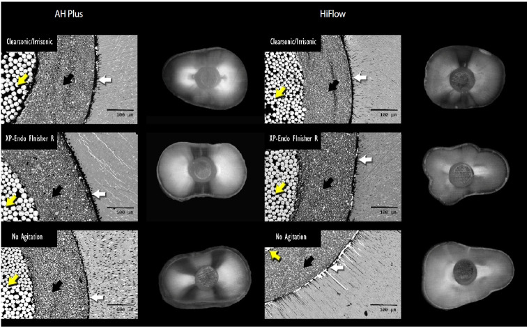 Cleaning protocols to enhance bond strength of fiberglass posts on root canals filled with bioceramic sealer: an in vitro comparative study.