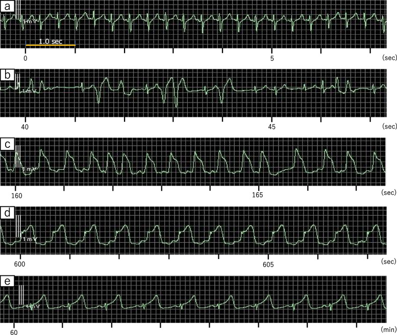 A case of abnormal hypertension and Takotsubo syndrome caused by adrenal hemostasis using an electric scalpel: a case report.