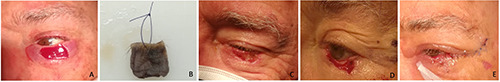 A delayed Tenzel flap.