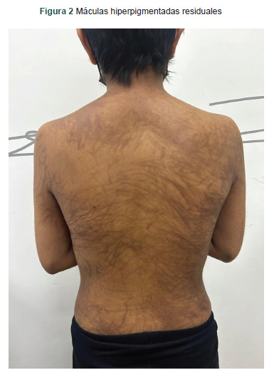 [Flagellate erythema secondary to bleomycin: case report with favorable outcome].