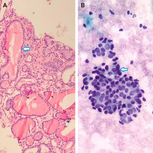 Diagnostic yield of fine needle aspiration with simultaneous core needle biopsy for thyroid nodules.