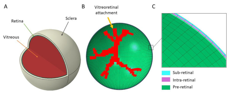 Finite element analysis of asymmetrical retinal hemorrhages in shaken baby syndrome.