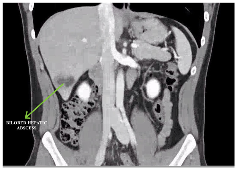 A 'Fluke' Diagnosis: Suspecting Fascioliasis as a Rare Cause of Hepatic Abscess.