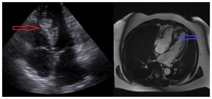 A Rare Discovery of Neuroendocrine Tumor: Cardiac Mass.