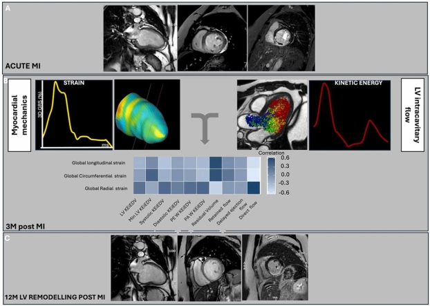 Left ventricular flow kinetics and myocardial deformation following acute infarction: Additional predictive value of cardiac magnetic resonance four-dimensional flow for left ventricular remodeling post-ST-elevation myocardial infarction.