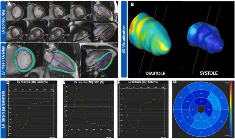 Left ventricular flow kinetics and myocardial deformation following acute infarction: Additional predictive value of cardiac magnetic resonance four-dimensional flow for left ventricular remodeling post-ST-elevation myocardial infarction.