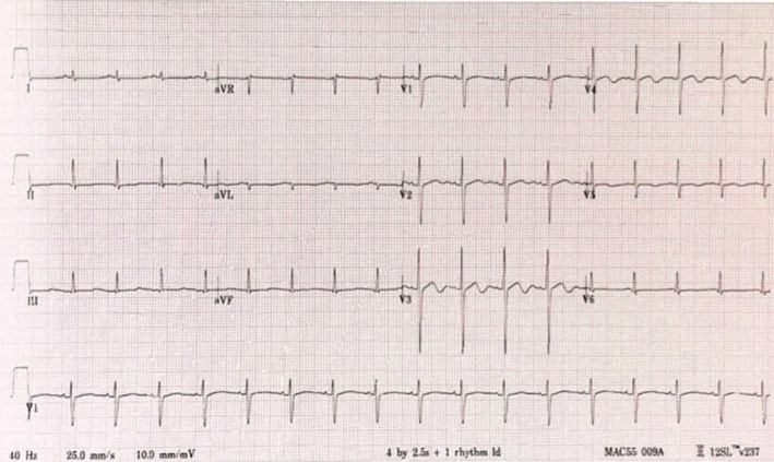 Acquired Genotype-Positive Long QT Syndrome After Pediatric Heart Transplantation.