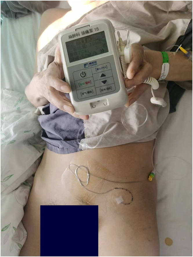 Clinical Value of Continuous Fascia Iliaca Compartment Block in Perioperative Management of Elderly Patients with Intertrochanteric Fracture: A Propensity Score-Matched Retrospective Study.