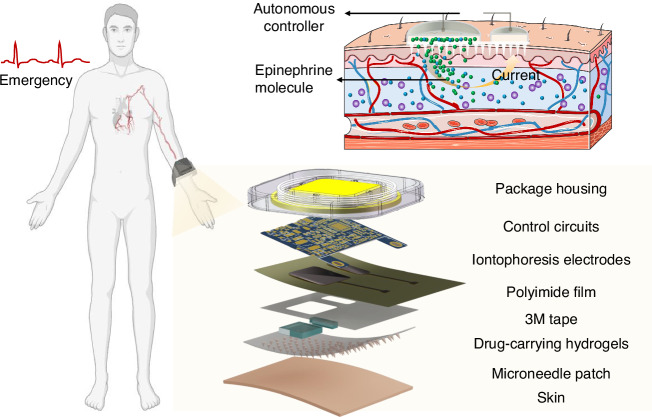 A wearable self-aid microneedle chip based on actively transdermal delivery of epinephrine.