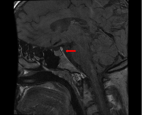 Unusual Long-Term Survival in an Adult Patient With Langerhans Cell Histiocytosis and Central Nervous System Involvement: A Case Report.