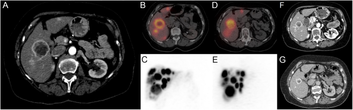 Radioembolization for neuroendocrine tumors: procedure, application and clinical outcomes.