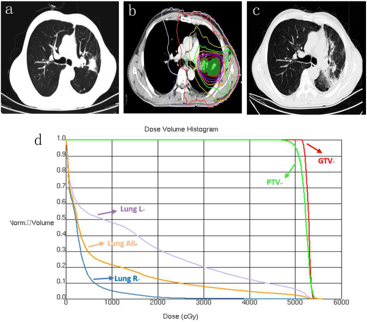 Risk factors for radiation pneumonitis in NSCLC patients treated with third-generation EGFR TKIs and chest radiotherapy.