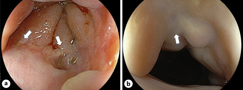 A Case of Postoperative Pouch-Vaginal Fistula of Ulcerative Colitis Successfully Treated with Estriol Vaginal Tablet.