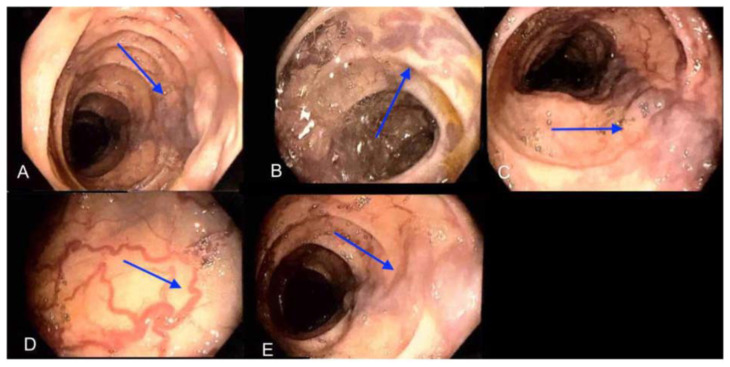It Runs in the Family: A Rare Case of Familial Idiopathic Colonic Varices.