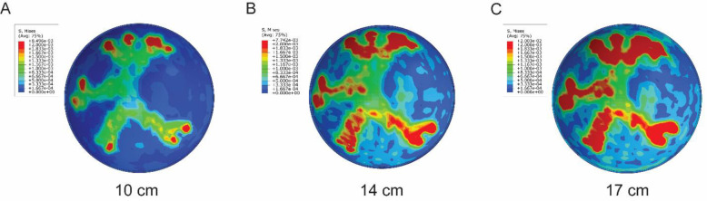 Finite element analysis of asymmetrical retinal hemorrhages in shaken baby syndrome.