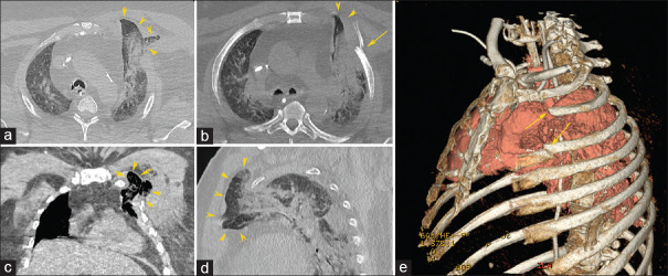 Lung herniation after cardiopulmonary resuscitation.