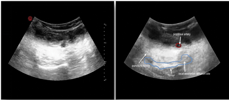 Analgesic Effect of Intermittent Multiple IPACK Block Combined with ACB in Patients with Flexion Contracture Knee Arthritis Undergoing Total Knee Arthroplasty.