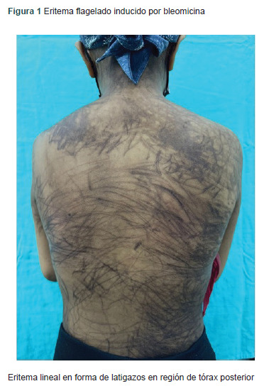 [Flagellate erythema secondary to bleomycin: case report with favorable outcome].