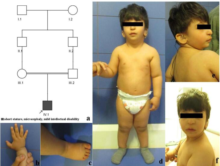 Expanding the Clinical Phenotype Associated with the <i>NIN</i> Gene; Report of a Patient with Short Stature, Microcephaly and Hearing Loss.