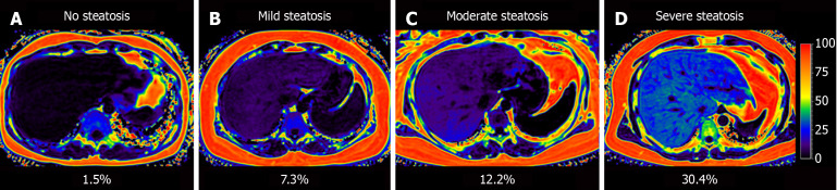 Diagnostic accuracy of noninvasive steatosis biomarkers with magnetic resonance imaging proton density fat fraction as gold standard.