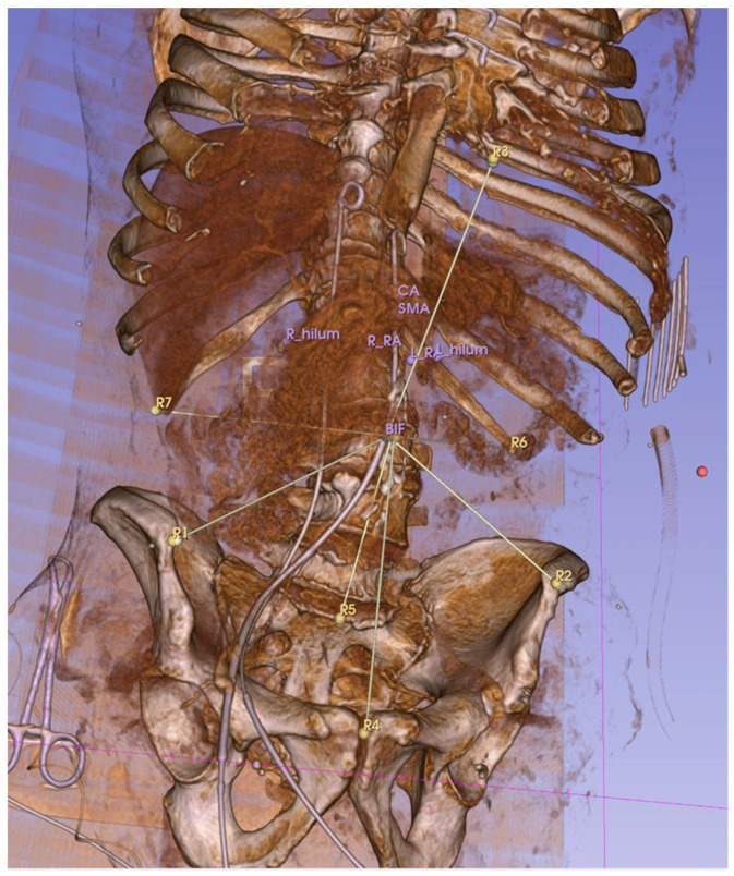 Early Concepts in CT Image-Guided Robotic Vascular Surgery: The Displacement of Retroperitoneal Structures During Simulated Procedures in a Cadaveric Model.