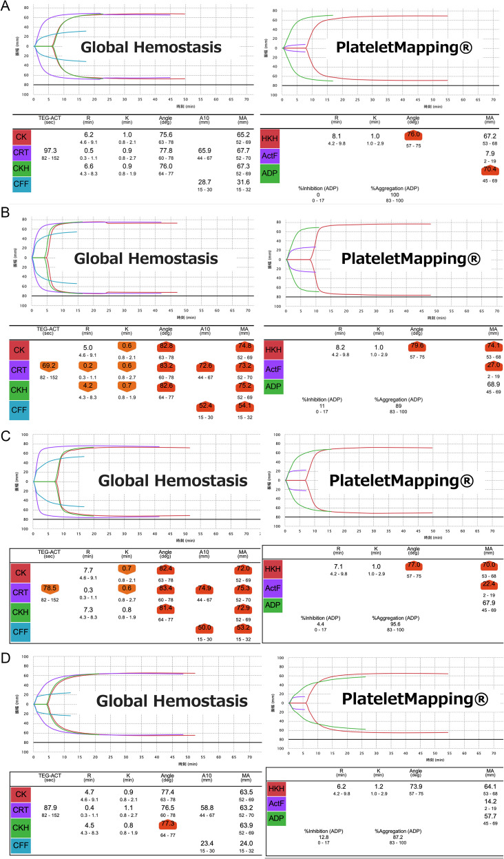 Comprehensive evaluation of coagulability using thromboelastography in four patients with essential thrombocythemia.