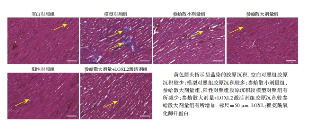 [Shenge powder inhibits myocardial fibrosis in rats with post-myocardial infarction heart failure through LOXL2/TGF-β1/IL-11 signaling pathway].