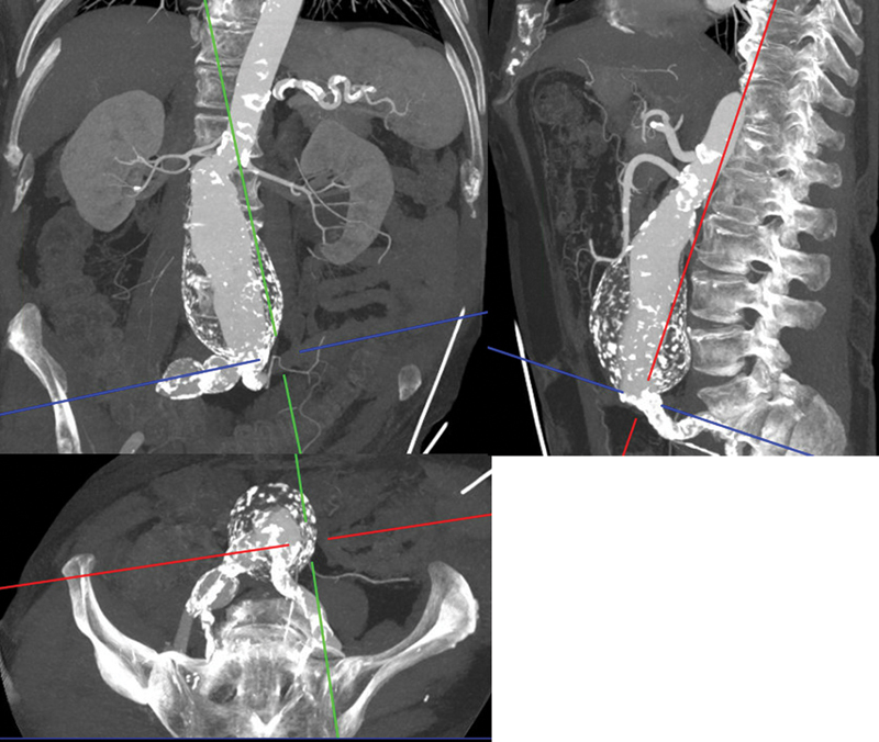 Staged Therapy of Polyaneurysmal Disease Including the World's First BeFlared Use in Anaconda FEVAR.