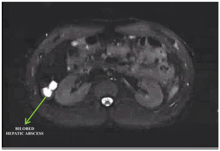 A 'Fluke' Diagnosis: Suspecting Fascioliasis as a Rare Cause of Hepatic Abscess.