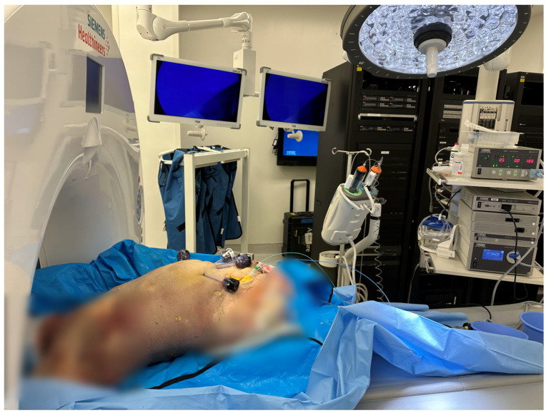Early Concepts in CT Image-Guided Robotic Vascular Surgery: The Displacement of Retroperitoneal Structures During Simulated Procedures in a Cadaveric Model.