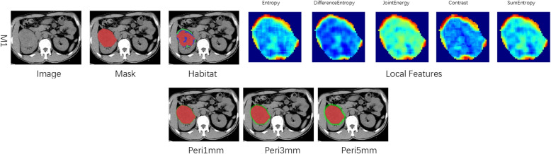 Preoperative prediction of WHO/ISUP grade of ccRCC using intratumoral and peritumoral habitat imaging: multicenter study.