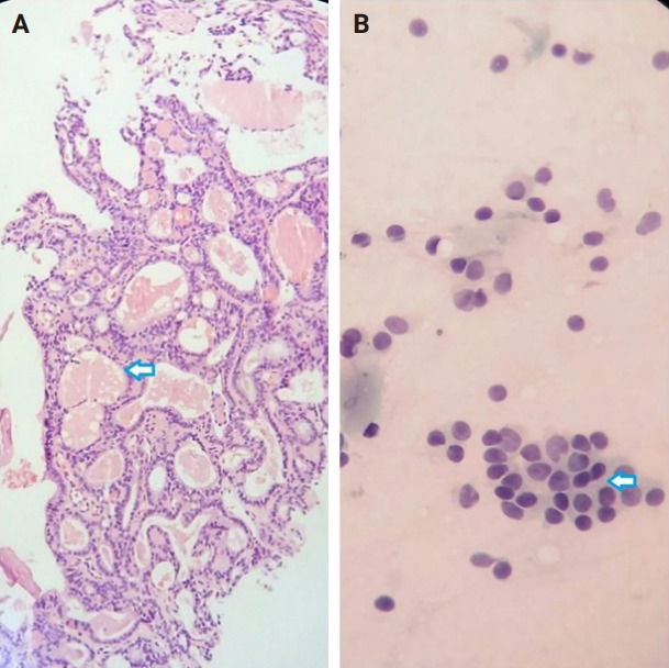 Diagnostic yield of fine needle aspiration with simultaneous core needle biopsy for thyroid nodules.