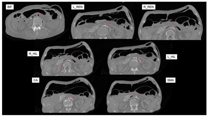 Early Concepts in CT Image-Guided Robotic Vascular Surgery: The Displacement of Retroperitoneal Structures During Simulated Procedures in a Cadaveric Model.