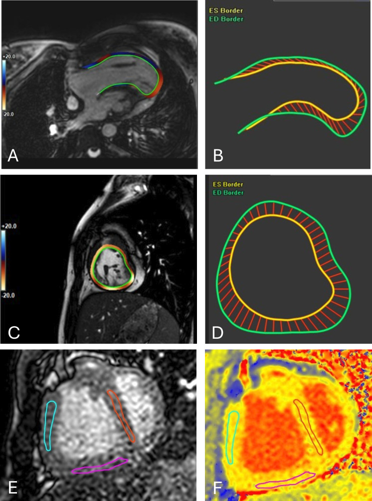 Cardiac MRI in patients with Fontan circulation: assessing risk factors for adverse outcomes.