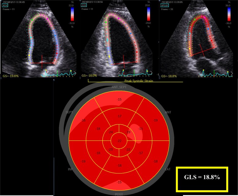 An echocardiographic prognostic risk stratification decision tree to determine adverse events in Anderson-Fabry disease.
