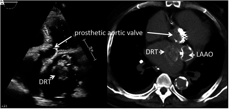 A Rare Case of a Decade-Long Device-Related Thrombus with a Unique "Tree-Ring" Structure.