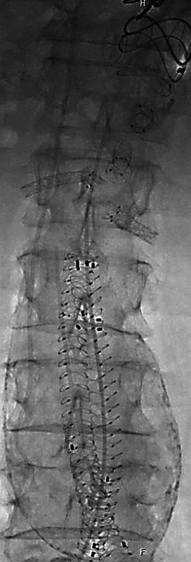 Staged Therapy of Polyaneurysmal Disease Including the World's First BeFlared Use in Anaconda FEVAR.