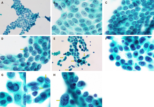 Cytological features of atypical adenomatous hyperplasia and adenocarcinoma in situ of the lung: a case report.