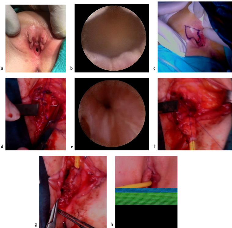 Perineal Approach for Female Epispadias Repair and Providing Continence