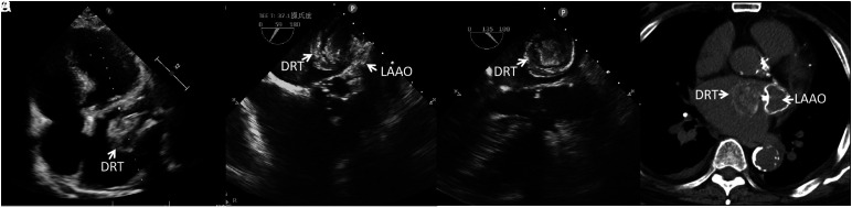 A Rare Case of a Decade-Long Device-Related Thrombus with a Unique "Tree-Ring" Structure.