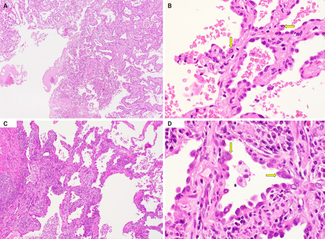 Cytological features of atypical adenomatous hyperplasia and adenocarcinoma in situ of the lung: a case report.